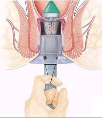 Emorroidi: terapia con ricovero breve, tecnica di Longo (prima)